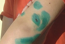 Овчарка прокусила руку ухтинки, мэрия компенсирует моральный вред пострадавшей